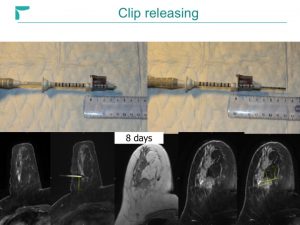 Breast MRI Interventional JFIM Mumbai 2016
