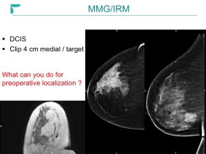 Breast MRI Interventional JFIM Mumbai 2016