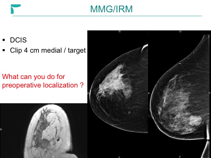Breast MRI Interventional JFIM Mumbai 2016