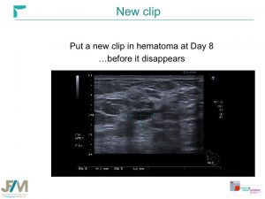 Breast MRI Interventional JFIM Mumbai 2016