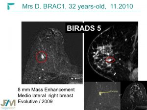 Breast MRI Interventional JFIM Mumbai 2016