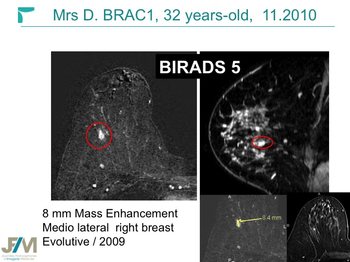 Breast MRI Interventional JFIM Mumbai 2016