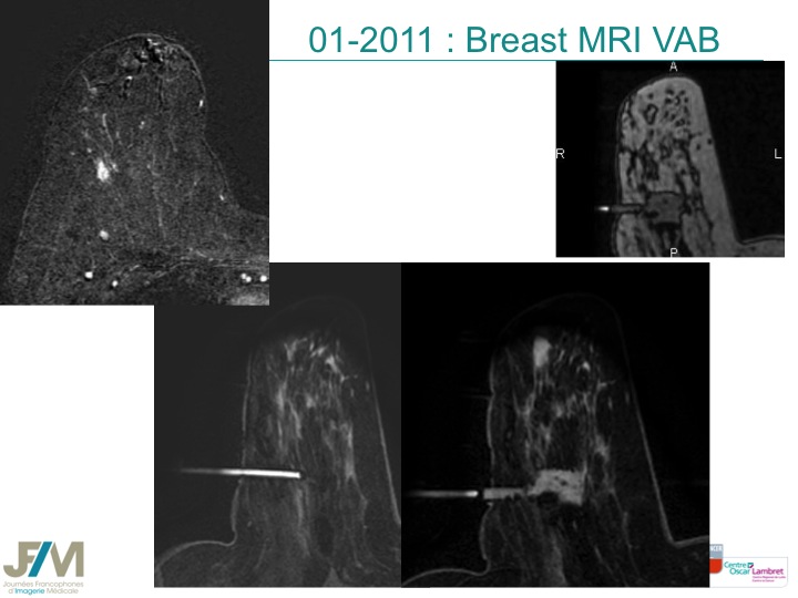 Breast MRI Interventional JFIM Mumbai 2016