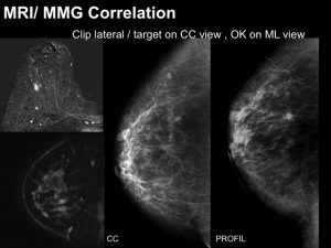 Breast MRI Interventional JFIM Mumbai 2016