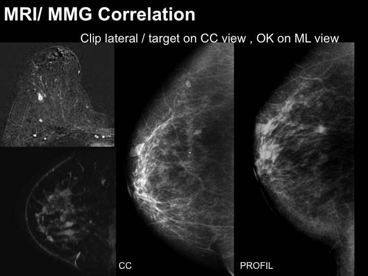 Breast MRI Interventional JFIM Mumbai 2016
