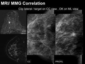 Breast MRI Interventional JFIM Mumbai 2016