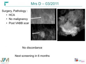 Breast MRI Interventional JFIM Mumbai 2016