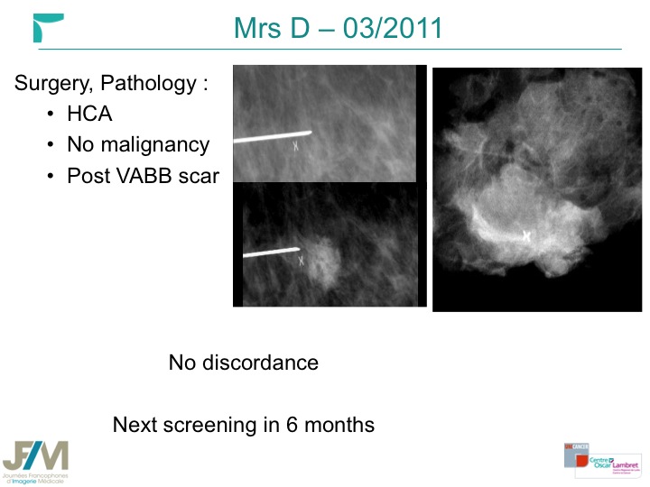 Breast MRI Interventional JFIM Mumbai 2016