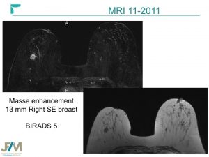 Breast MRI Interventional JFIM Mumbai 2016