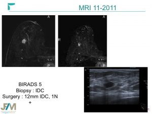 Breast MRI Interventional JFIM Mumbai 2016