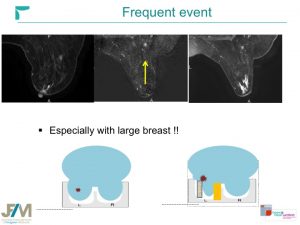Breast MRI Interventional JFIM Mumbai 2016