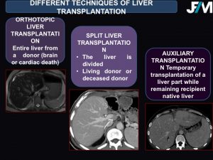 L ARRIVE Liver Transplantation JFIM Mumbai 2016
