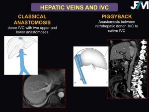 L ARRIVE Liver Transplantation JFIM Mumbai 2016
