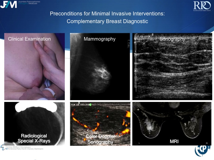 Percutaneous Breast lesion Ablation: When avoid Open Surgery?