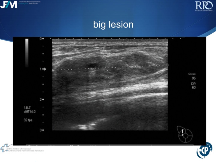 Percutaneous Breast lesion Ablation: When avoid Open Surgery?