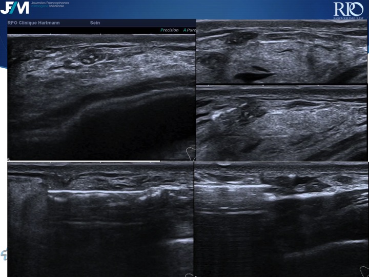 Percutaneous Breast lesion Ablation: When avoid Open Surgery?