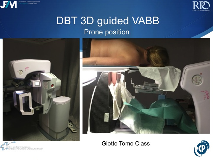 Percutaneous Breast lesion Ablation: When avoid Open Surgery?