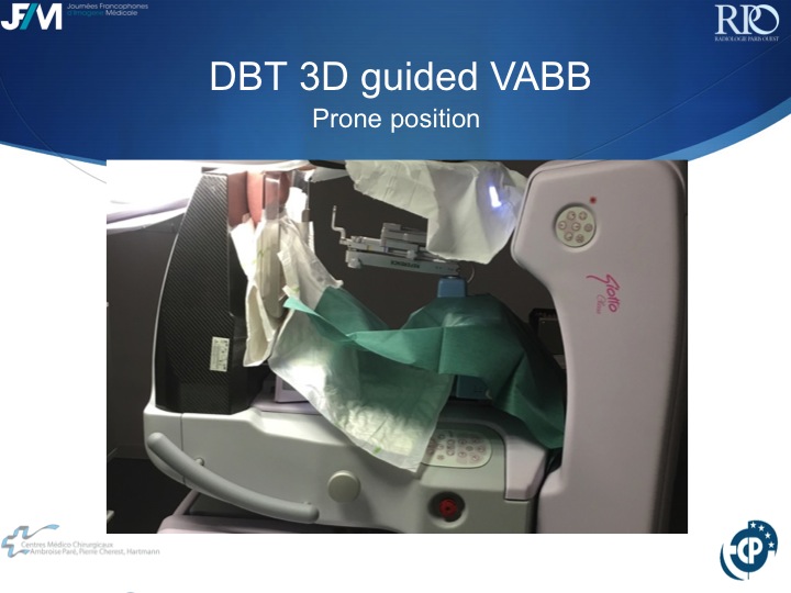 Percutaneous Breast lesion Ablation: When avoid Open Surgery?