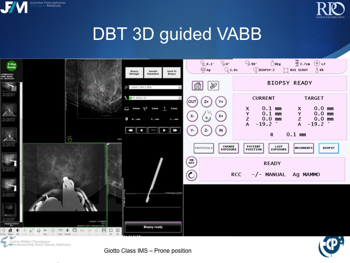 Percutaneous Breast lesion Ablation: When avoid Open Surgery?