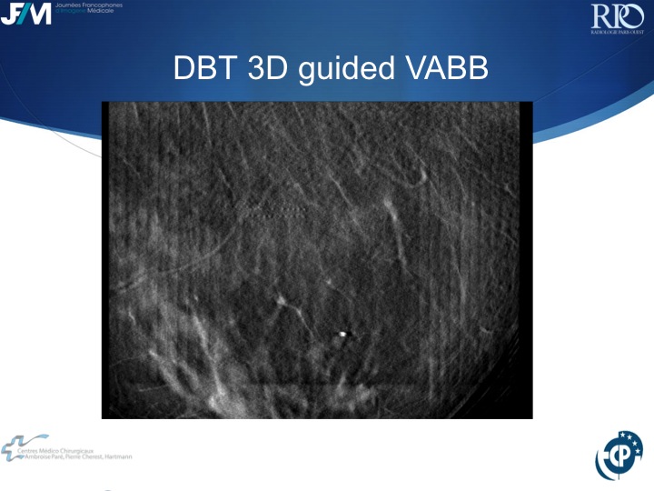 Percutaneous Breast lesion Ablation: When avoid Open Surgery?