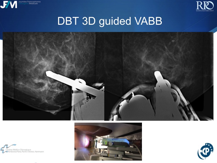 Percutaneous Breast lesion Ablation: When avoid Open Surgery?