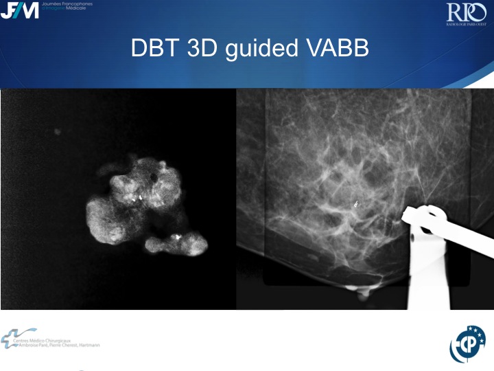 Percutaneous Breast lesion Ablation: When avoid Open Surgery?