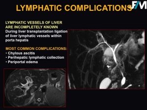 L ARRIVE Liver Transplantation JFIM Mumbai 2016