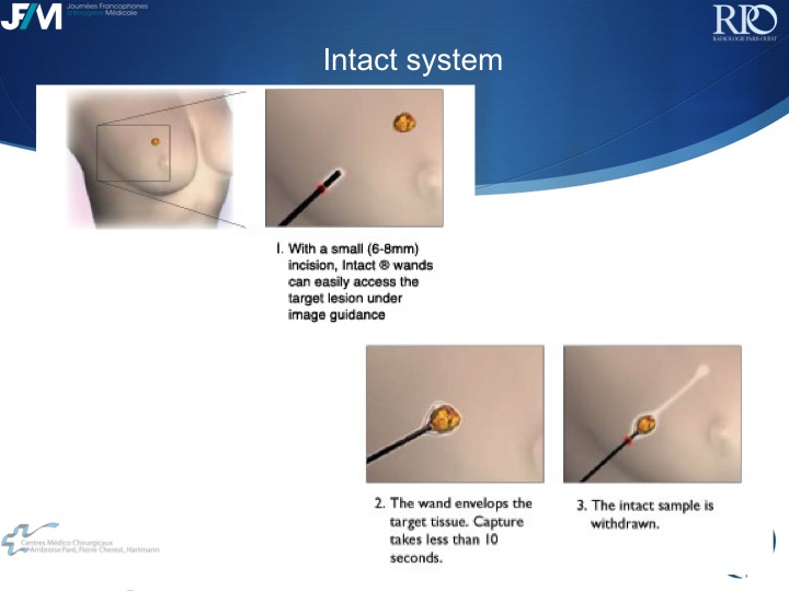 Percutaneous Breast lesion Ablation: When avoid Open Surgery?