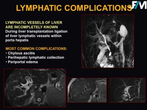 L ARRIVE Liver Transplantation JFIM Mumbai 2016