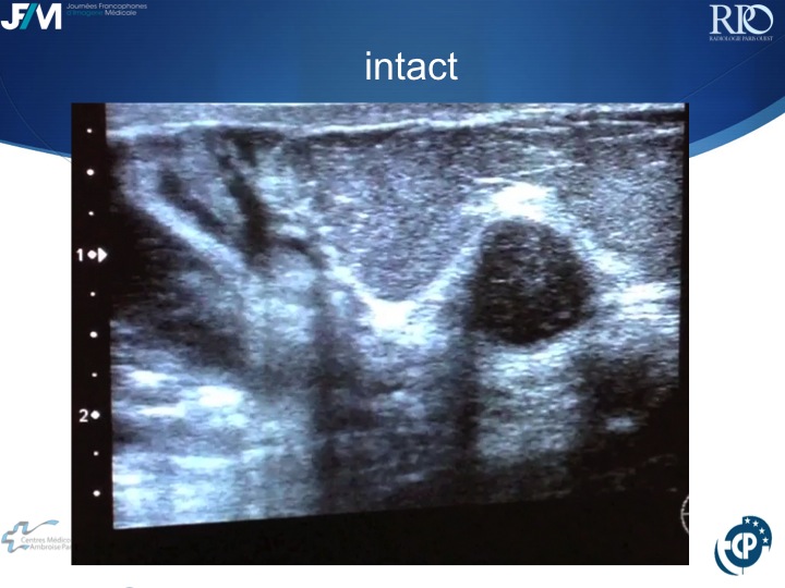 Percutaneous Breast lesion Ablation: When avoid Open Surgery?