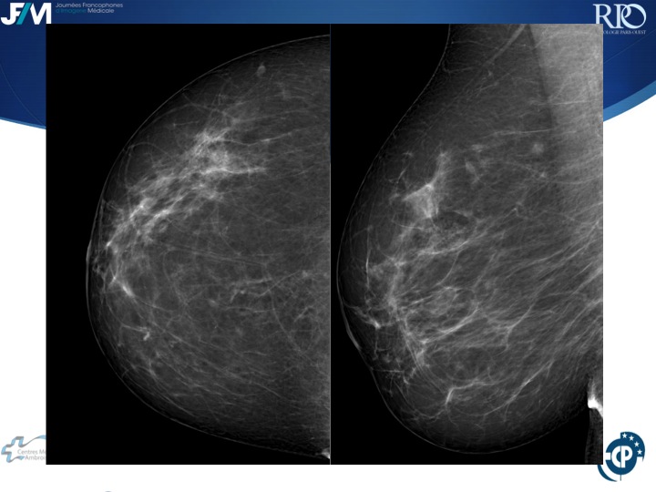 Percutaneous Breast lesion Ablation: When avoid Open Surgery?