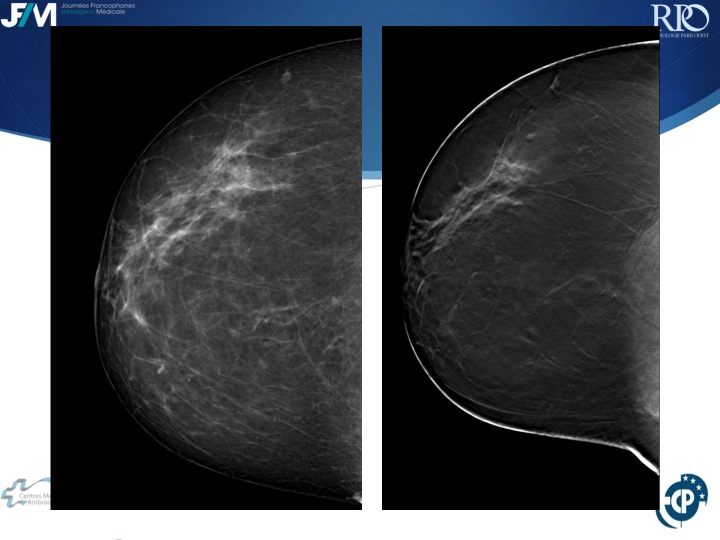 Percutaneous Breast lesion Ablation: When avoid Open Surgery?
