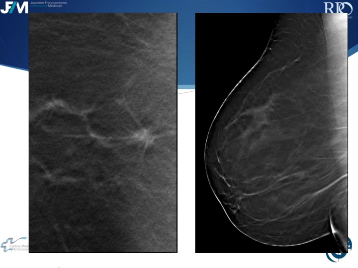 Percutaneous Breast lesion Ablation: When avoid Open Surgery?