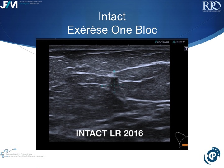 Percutaneous Breast lesion Ablation: When avoid Open Surgery?
