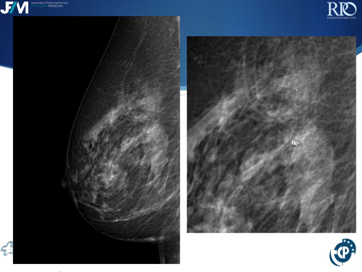 Percutaneous Breast lesion Ablation: When avoid Open Surgery?