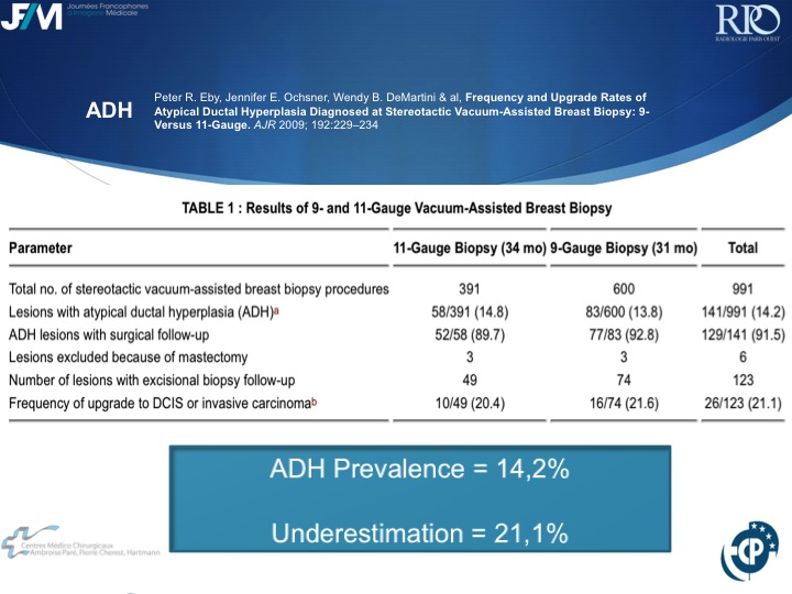 Percutaneous Breast lesion Ablation: When avoid Open Surgery?