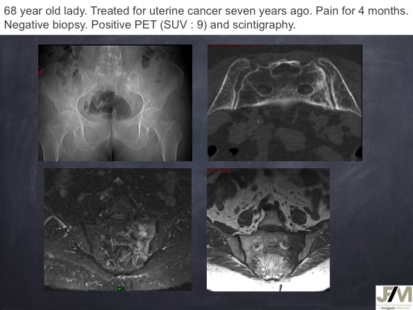 Mistakes in diagnosing of a Bone Tumor