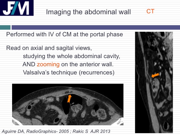 CT findings after abdominal wall repair surgery