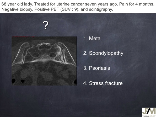 Mistakes in diagnosing of a Bone Tumor