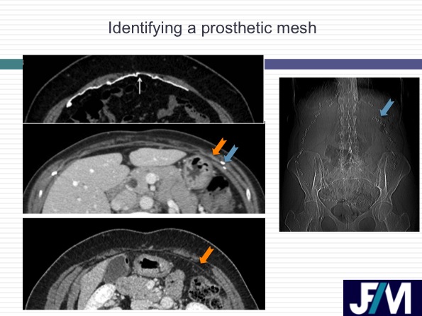 CT findings after abdominal wall repair surgery