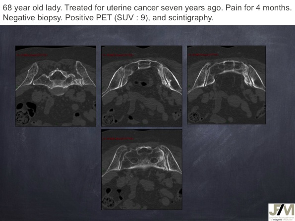 Mistakes in diagnosing of a Bone Tumor