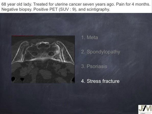Mistakes in diagnosing of a Bone Tumor