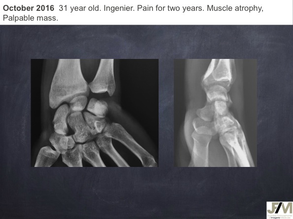 Mistakes in diagnosing of a Bone Tumor