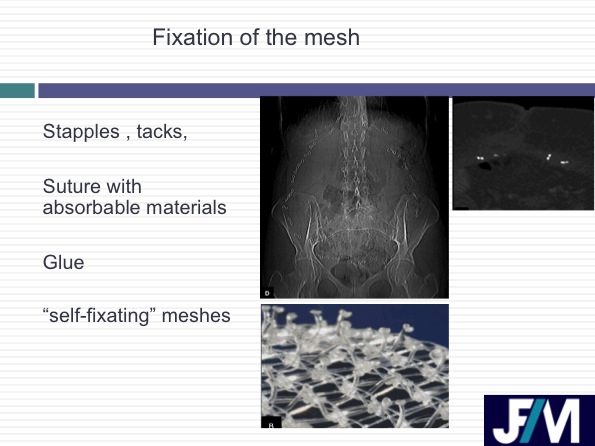 CT findings after abdominal wall repair surgery