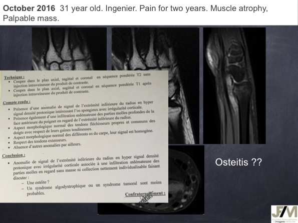 Mistakes in diagnosing of a Bone Tumor