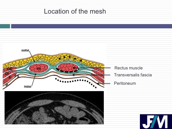 CT findings after abdominal wall repair surgery