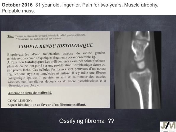 Mistakes in diagnosing of a Bone Tumor