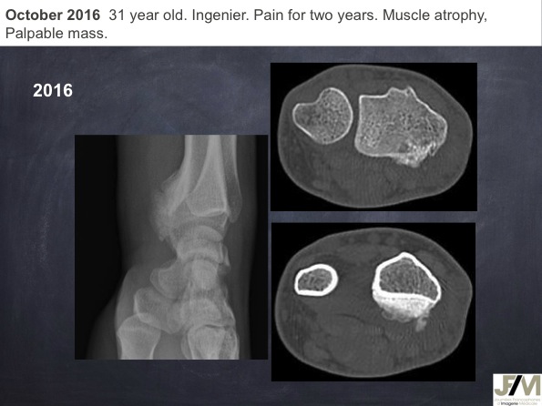 Mistakes in diagnosing of a Bone Tumor
