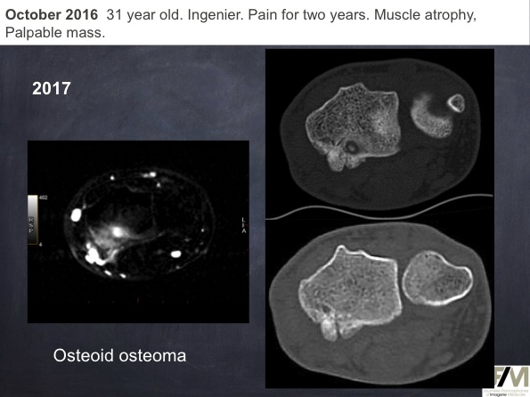Mistakes in diagnosing of a Bone Tumor