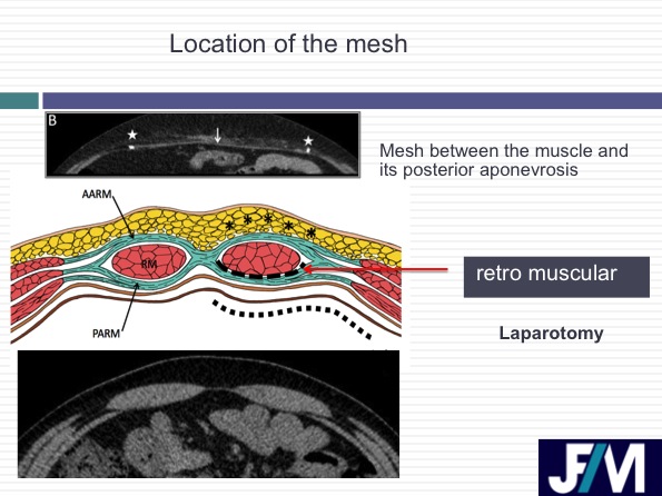CT findings after abdominal wall repair surgery
